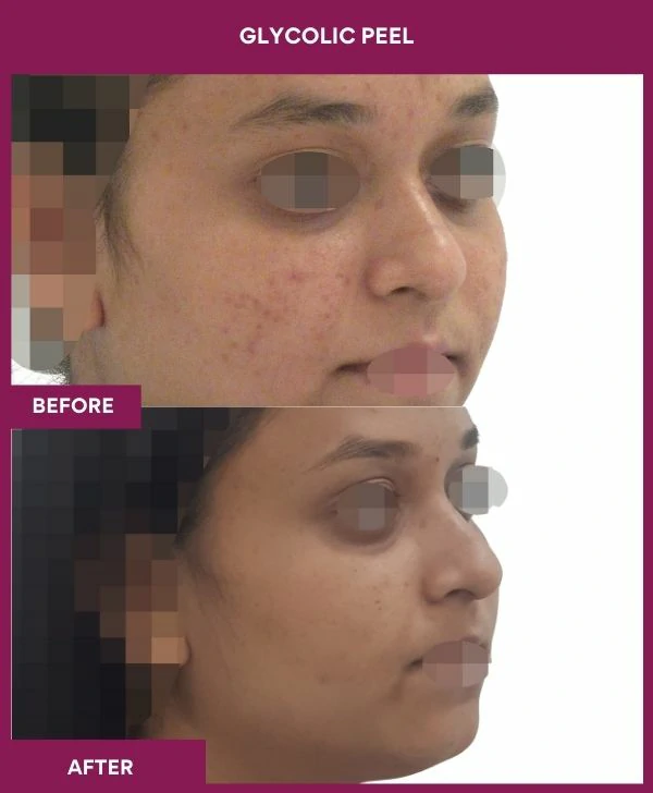 glycolic-peel-treatment-before-after-results-mumbai-india-patient09-side-right