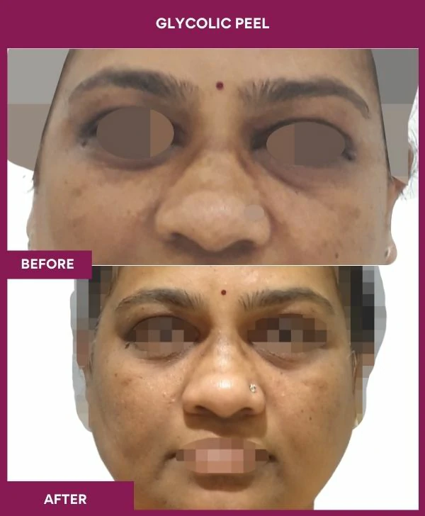 glycolic-peel-treatment-before-after-results-mumbai-india-patient10-front