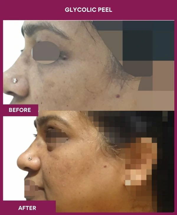 glycolic-peel-treatment-before-after-results-mumbai-india-patient10-side-left