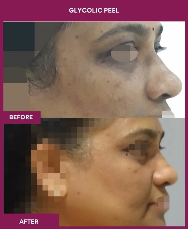 glycolic-peel-treatment-before-after-results-mumbai-india-patient10-side-right