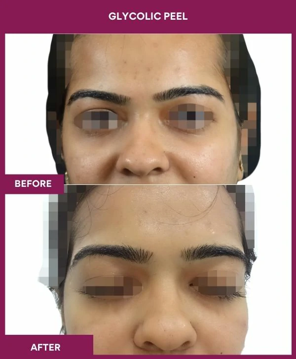 glycolic-peel-treatment-before-after-results-mumbai-india-patient11-front
