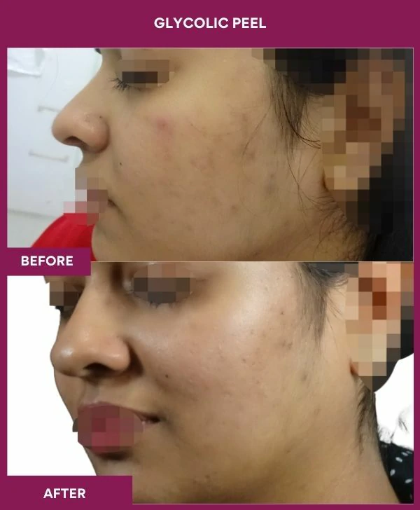 glycolic-peel-treatment-before-after-results-mumbai-india-patient11-side-left