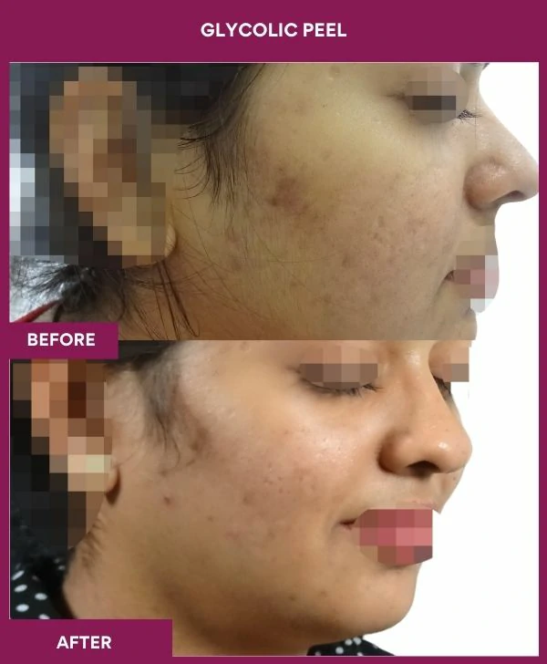 glycolic-peel-treatment-before-after-results-mumbai-india-patient11-side-right