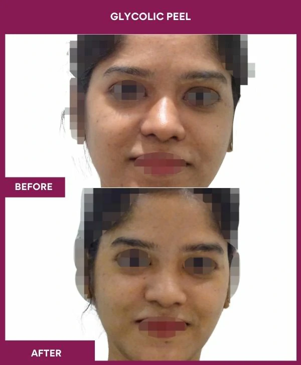 glycolic-peel-treatment-before-after-results-mumbai-india-patient12-front