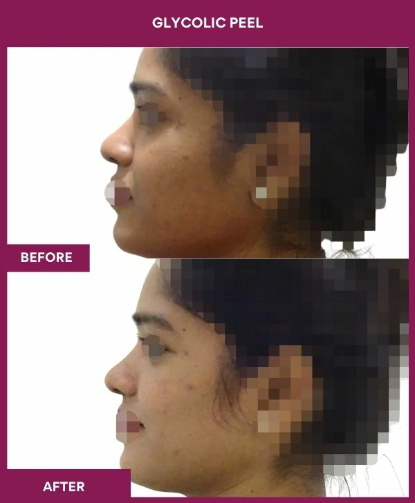 glycolic-peel-treatment-before-after-results-mumbai-india-patient12-side-left