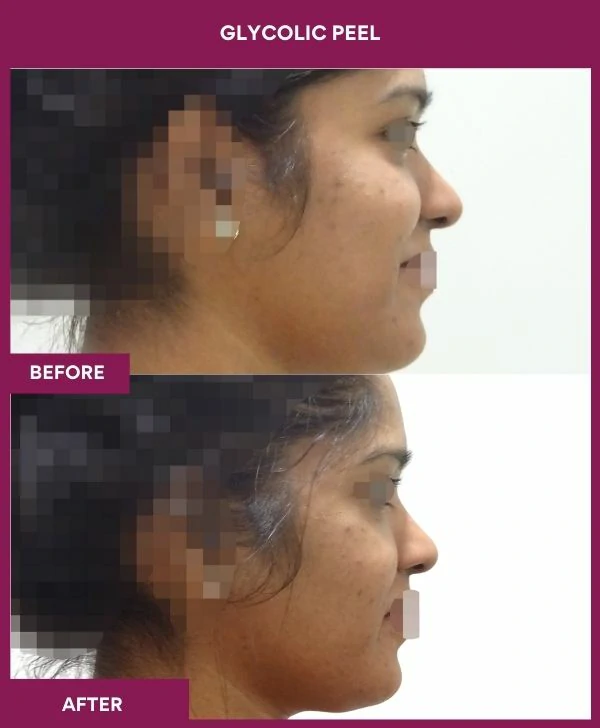 glycolic-peel-treatment-before-after-results-mumbai-india-patient12-side-right