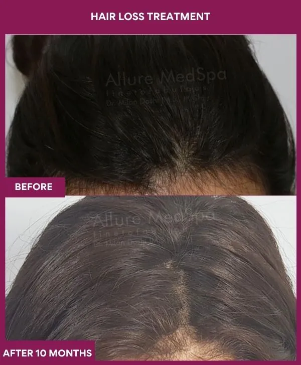 hair-loss-treatment-before-after-results-mumbai-india-patient02-front
