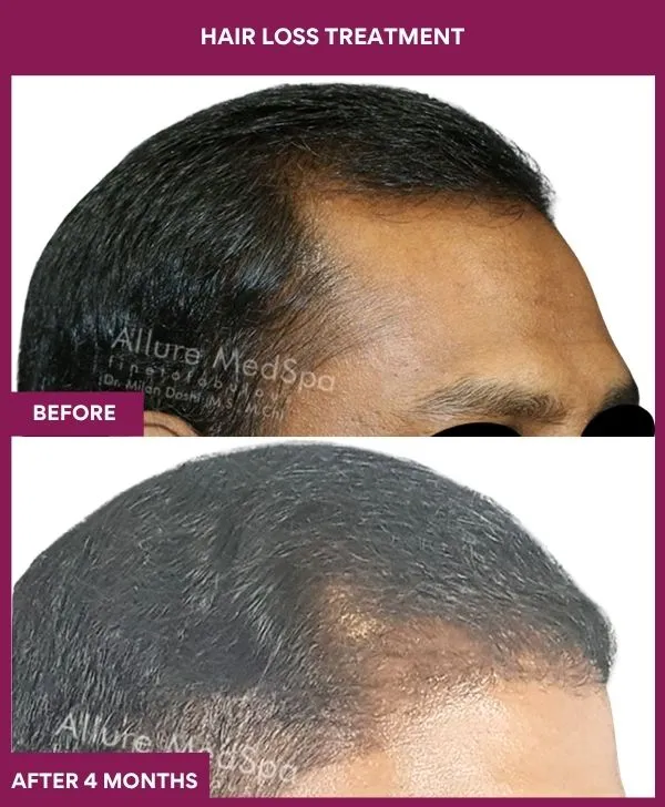 hair-loss-treatment-before-after-results-mumbai-india-patient03-side-right