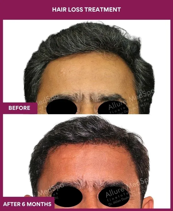 hair-loss-treatment-before-after-results-mumbai-india-patient04-front