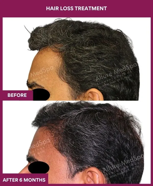 hair-loss-treatment-before-after-results-mumbai-india-patient04-side-left
