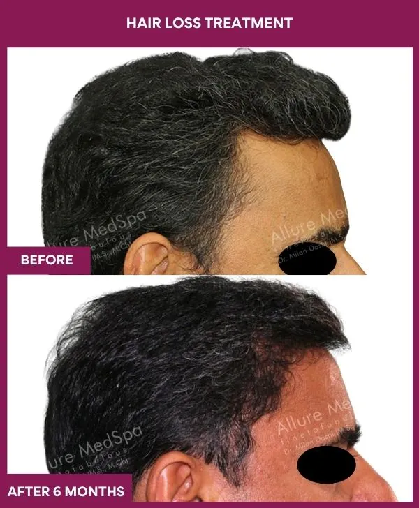 hair-loss-treatment-before-after-results-mumbai-india-patient04-side-right