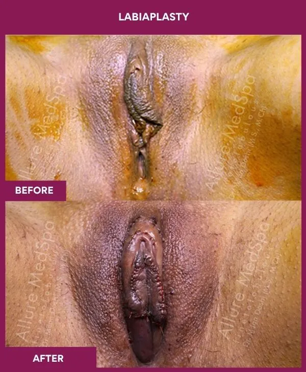 labiaplasty-before-after-results-mumbai-india-patient01-front-closed