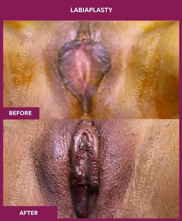 labiaplasty-before-after-results-mumbai-india-patient01-front-open