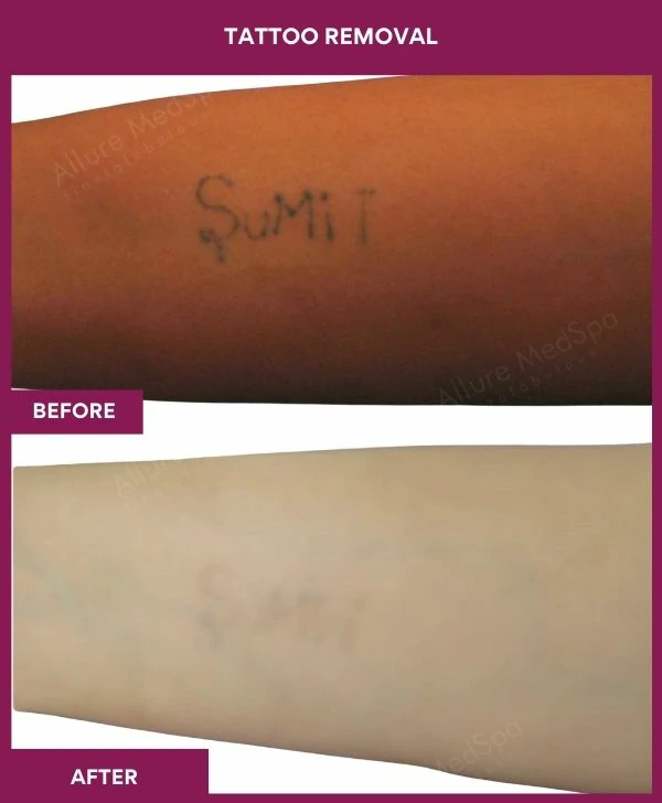 laser-tattoo-removal-arm-before-after-results-mumbai-india-patient01