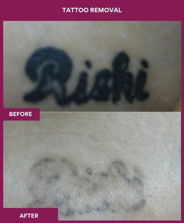 laser-tattoo-removal-arm-before-after-results-mumbai-india-patient02