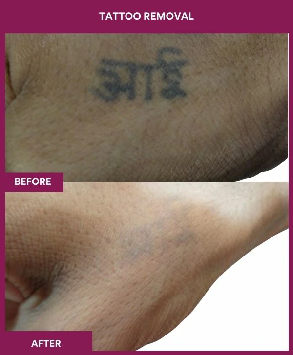 laser-tattoo-removal-arm-before-after-results-mumbai-india-patient03