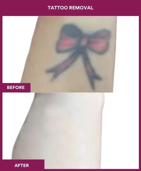 laser-tattoo-removal-arm-before-after-results-mumbai-india-patient06