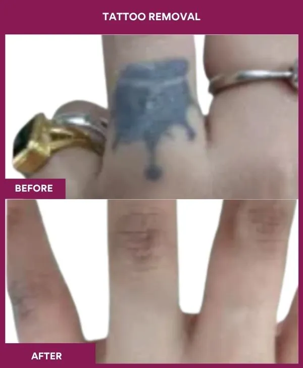 laser-tattoo-removal-arm-before-after-results-mumbai-india-patient07