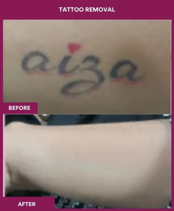 laser-tattoo-removal-arm-before-after-results-mumbai-india-patient08