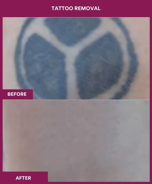 laser-tattoo-removal-before-after-results-mumbai-india-patient10