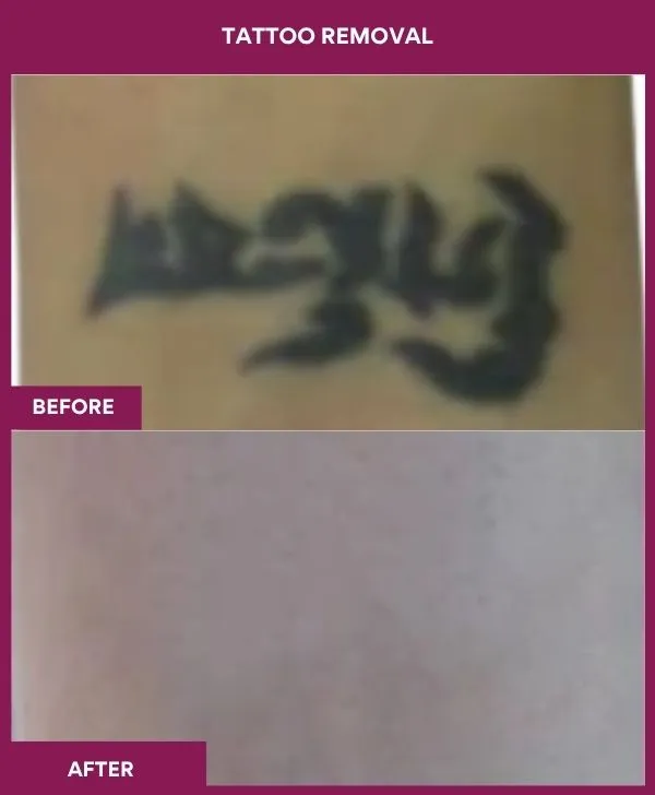 laser-tattoo-removal-before-after-results-mumbai-india-patient11