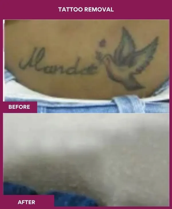 laser-tattoo-removal-belly-before-after-results-mumbai-india-patient09