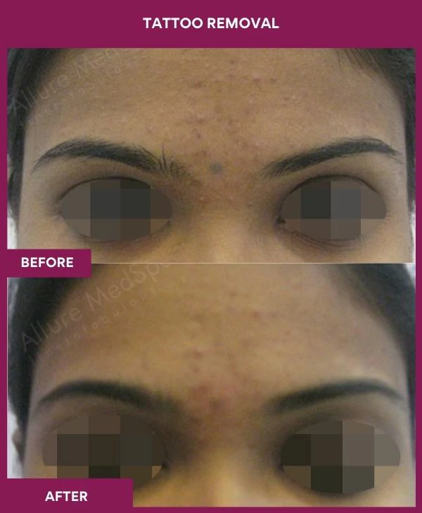 laser-tattoo-removal-forehead-before-after-results-mumbai-india-patient05