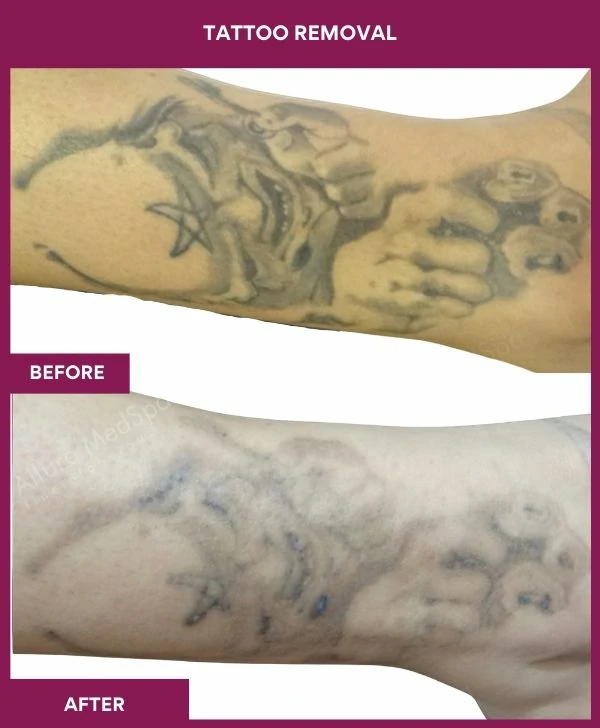 laser-tattoo-removal-leg-before-after-results-mumbai-india-patient04