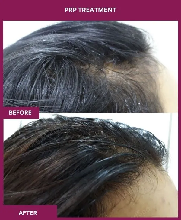 prp-hair-treatment-before-after-results-mumbai-india-patient01-side-right
