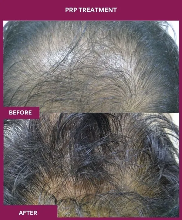 prp-hair-treatment-before-after-results-mumbai-india-patient02-side-front