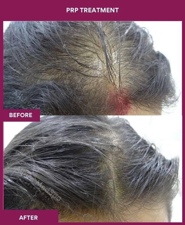 prp-hair-treatment-before-after-results-mumbai-india-patient03-side-front
