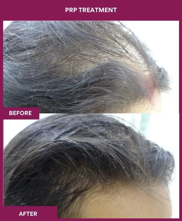 prp-hair-treatment-before-after-results-mumbai-india-patient03-side-right