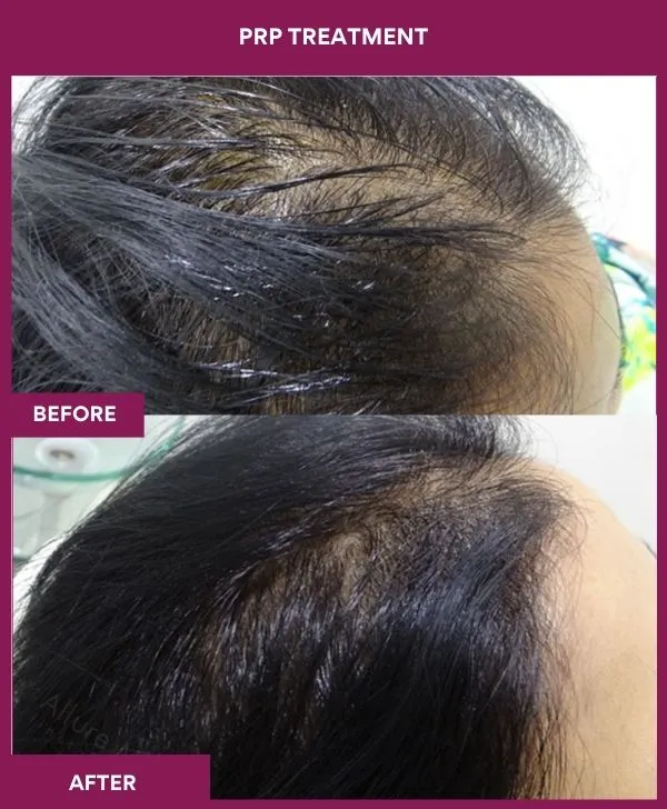 prp-hair-treatment-before-after-results-mumbai-india-patient04-side-right
