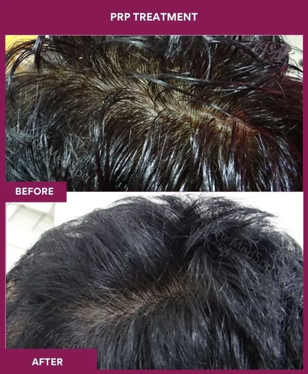 prp-hair-treatment-before-after-results-mumbai-india-patient05-side-left