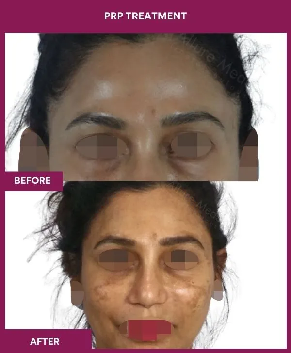 prp-hair-treatment-before-after-results-mumbai-india-patient06-front