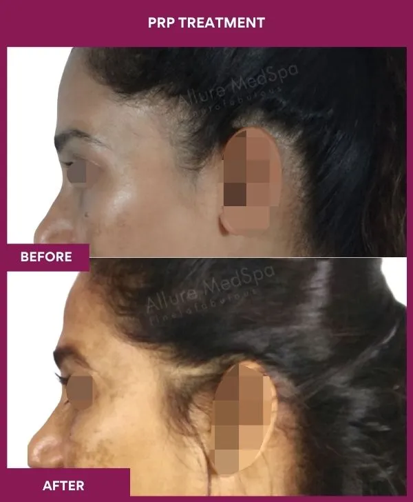 prp-hair-treatment-before-after-results-mumbai-india-patient06-side-left