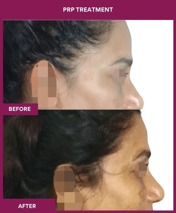 prp-hair-treatment-before-after-results-mumbai-india-patient06-side-right