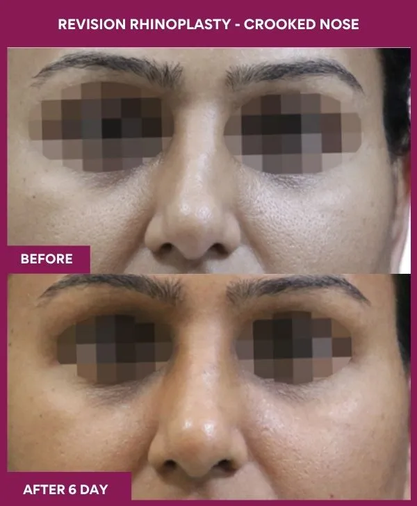 revision-rhinoplasty-crooked-nose-patient02-front