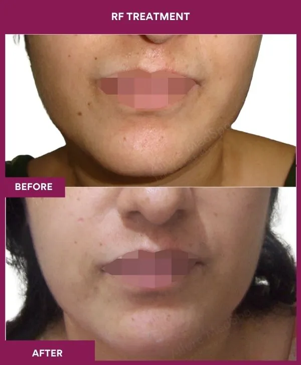 rf-microneedling-treatment-before-after-results-mumbai-patient01-front