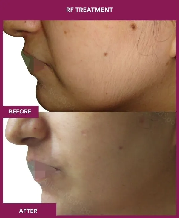 rf-microneedling-treatment-before-after-results-mumbai-patient01-side-left