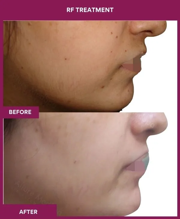 rf-microneedling-treatment-before-after-results-mumbai-patient01-side-right