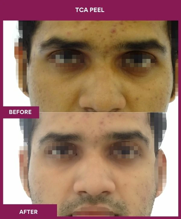 tca-peel-treatment-before-after-results-mumbai-india-patient01-front