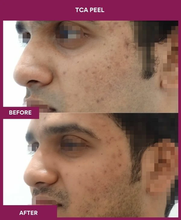 tca-peel-treatment-before-after-results-mumbai-india-patient01-side-left