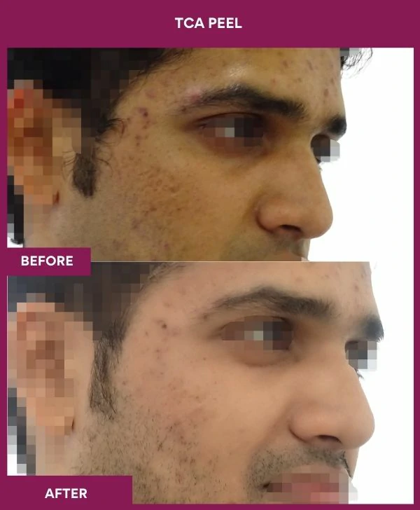 tca-peel-treatment-before-after-results-mumbai-india-patient01-side-right
