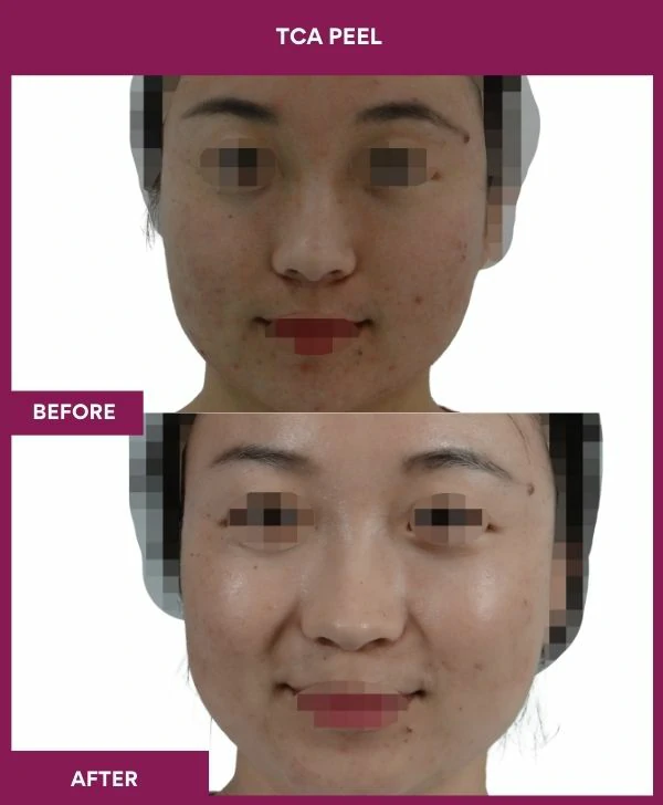 tca-peel-treatment-before-after-results-mumbai-india-patient02-front