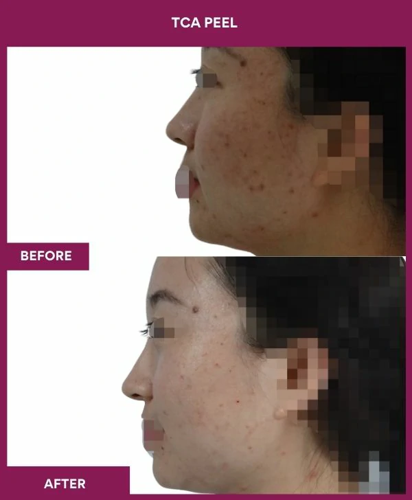 tca-peel-treatment-before-after-results-mumbai-india-patient02-side-left