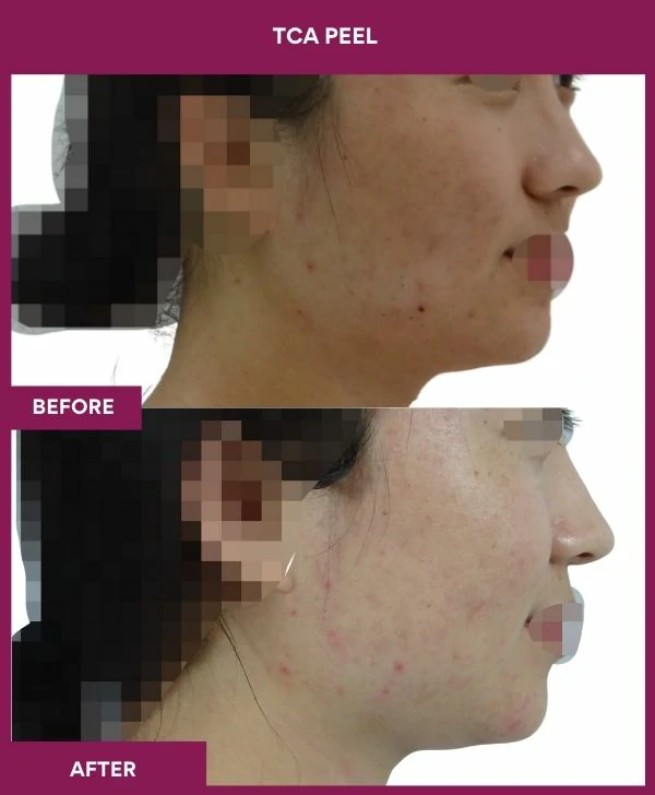 tca-peel-treatment-before-after-results-mumbai-india-patient02-side-right