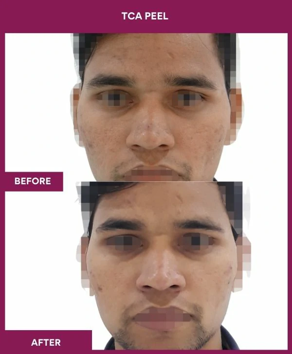tca-peel-treatment-before-after-results-mumbai-india-patient03-front