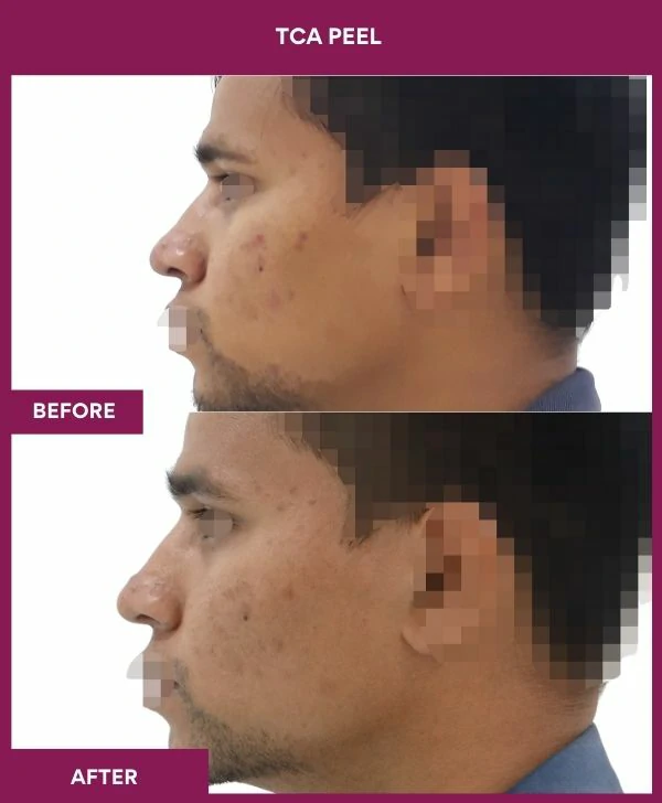 tca-peel-treatment-before-after-results-mumbai-india-patient03-side-left