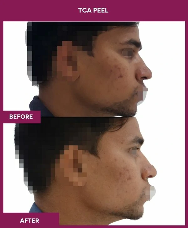 tca-peel-treatment-before-after-results-mumbai-patient03-side-right